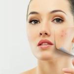 Kako se riješiti ožiljaka na licu: najučinkovitiji načini Liječenje ožiljaka na licu