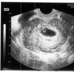 Prvi mjesec trudnoće što je moguće, a što ne