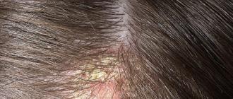 Kako oprati kosu katranskim sapunom za seboreični dermatitis?